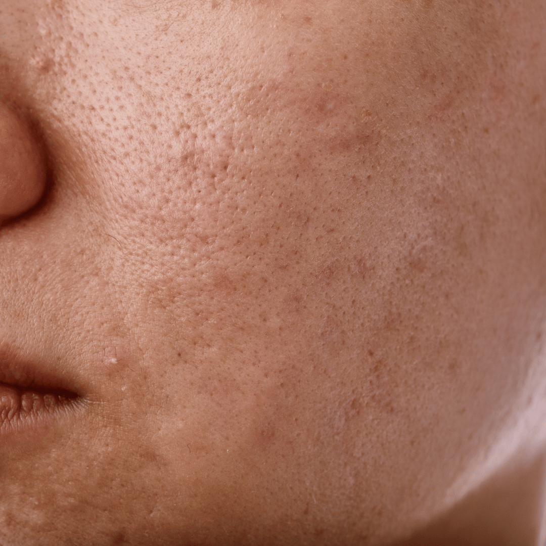 Uneven Skin Tone