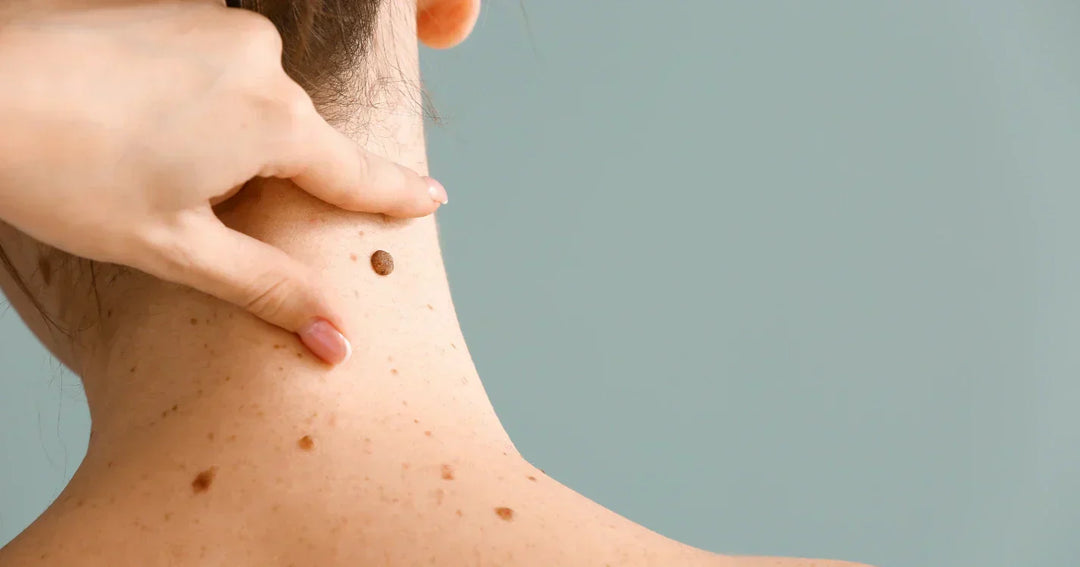 Mole Removal: When to Worry and How to Remove Safely
