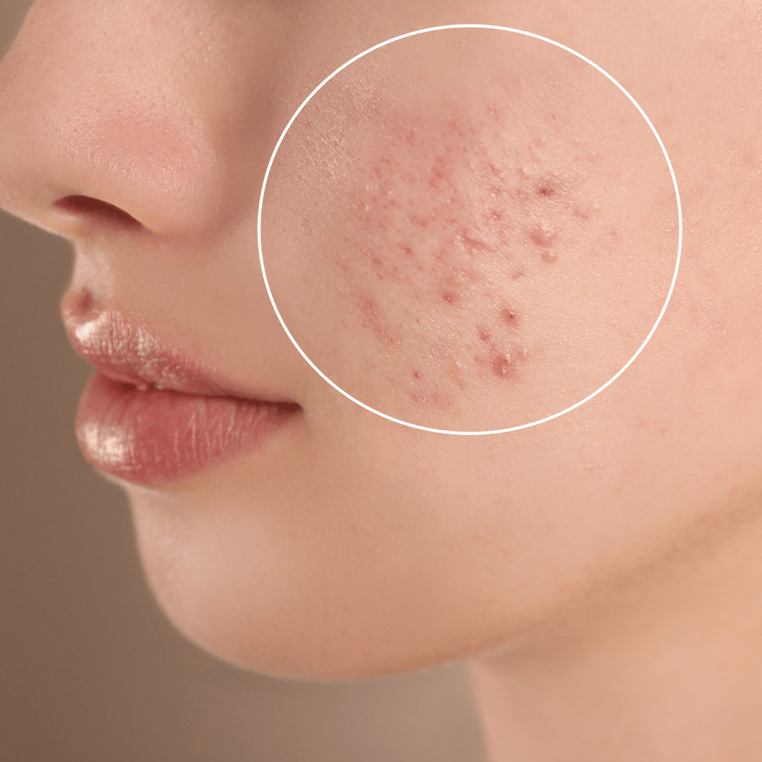Woman with acne