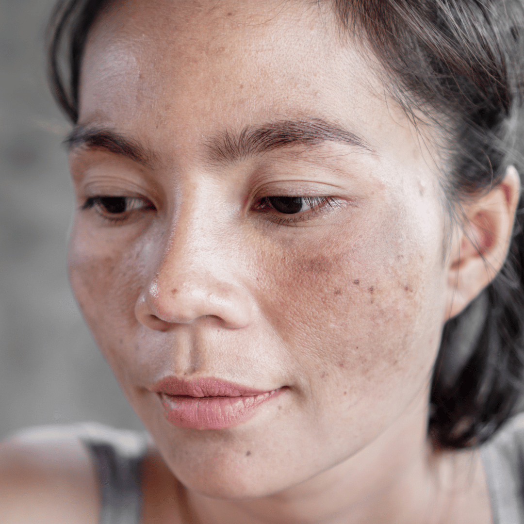 Hyperpigmentation and Dark Spots