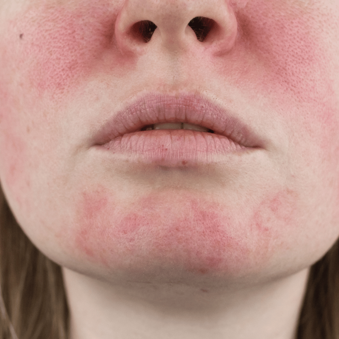 Redness and Rosacea