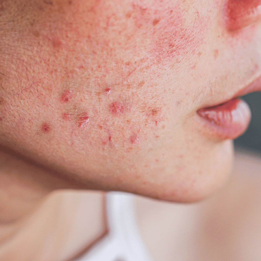 Acne Prone and Blemishes